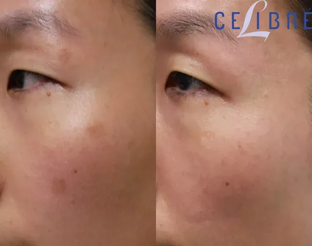 Reveal clearer skin with Asian-skin-brown-spot-removal-before-after-laser results