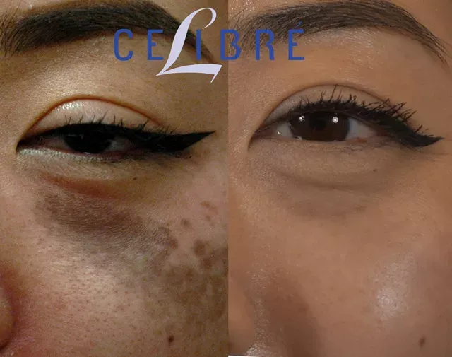 Nevus of ota laser birthmark removal before after