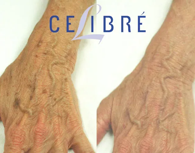 Age-spot-removal-on-the-hands-before-after shows clearer, younger-looking skin with noticeable spot reduction.