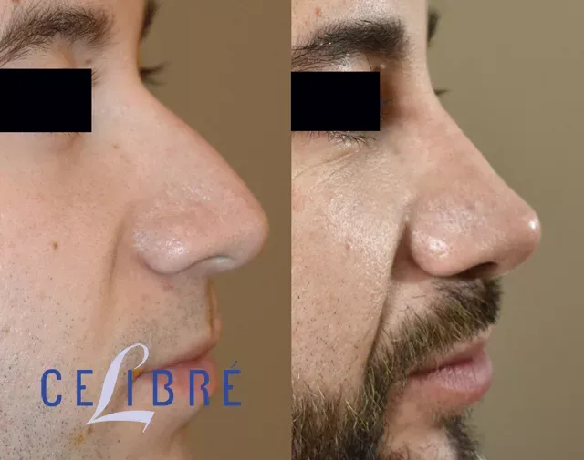 Enhance your profile with nose-shaping-with-filler-before-after results