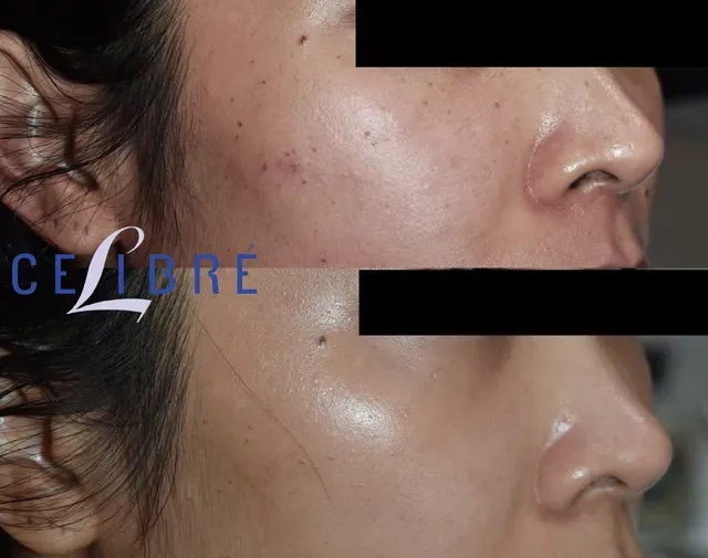 DPN-mole-removal-asian-patient shows clear, smooth skin with safe and effective mole removal.