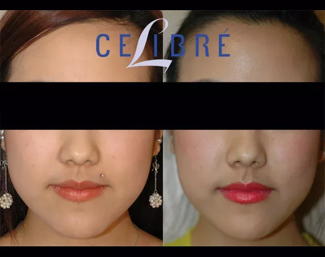 See a slimmer, defined look with asian-jaw-reduction-botox-before-after results