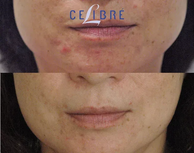 Relieve pain and tension with Botox-migraines-from-clenching-before-after results