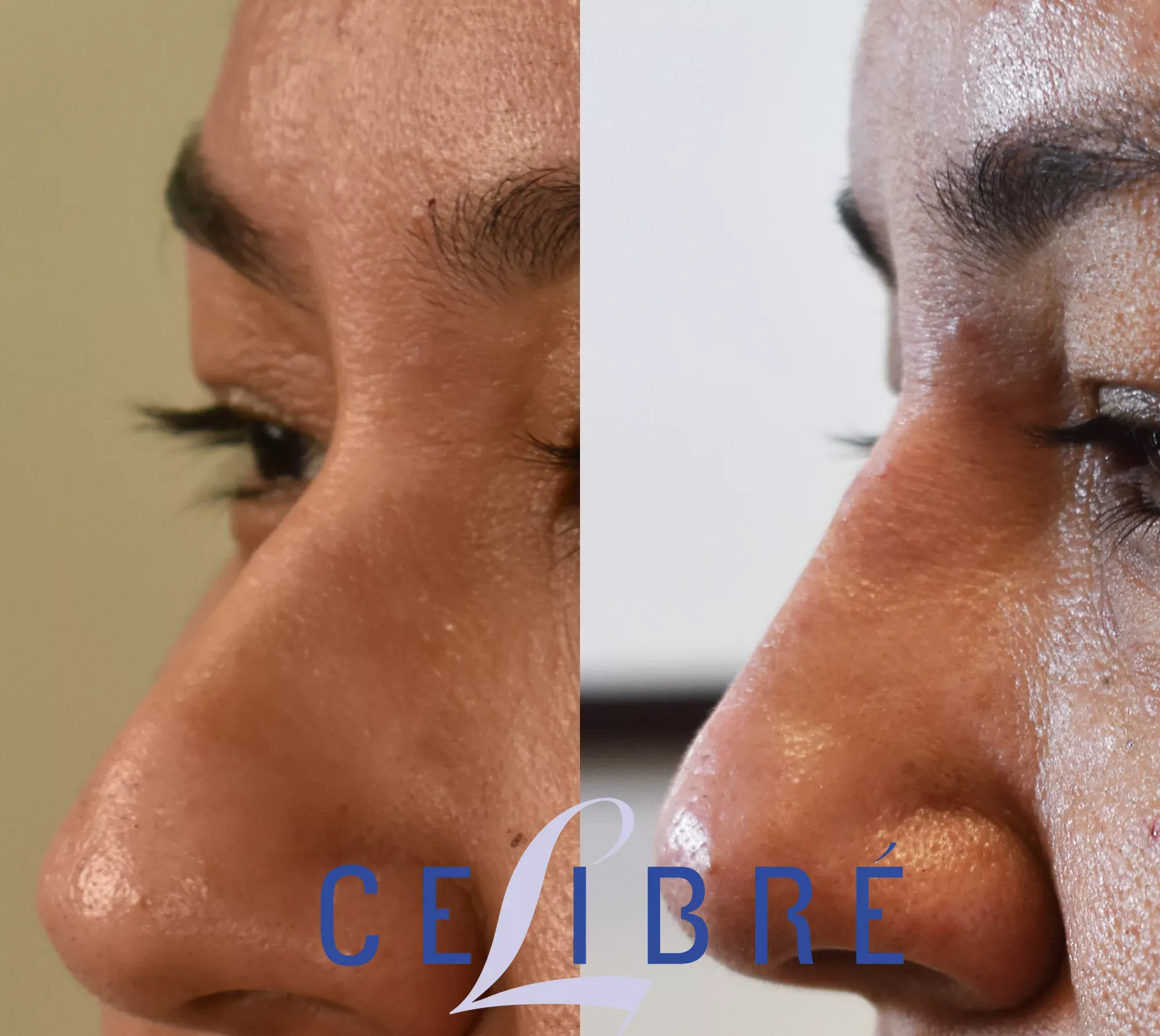 View pictures-of-dermal-filler-nose-job showing stunning before-and-after transformations for a natural look