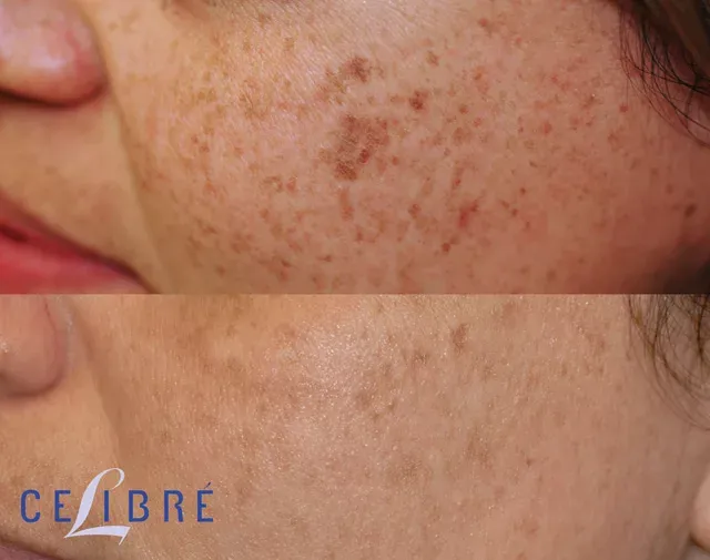 Achieve flawless skin with Asian-skin-laser-freckle-removal for a brighter, even-toned complexion