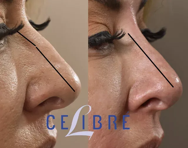 Discover if can-filler-work-for-non-surgical-nose-job to achieve a refined, natural-looking nose safely