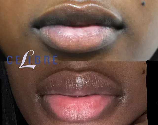 Laser-for-dark-spots-on-the-l shows smoother, clearer lips with noticeable dark spot reduction.