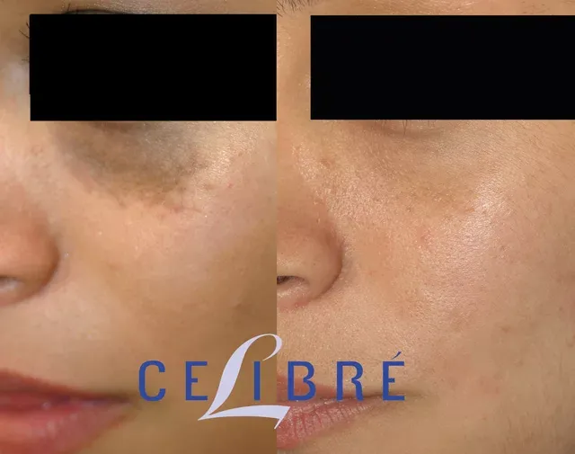 Find effective nevus-of-ota-laser-birthmark-removal-near-me treatments for clearer, smoother skin today