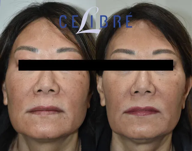 Achieve a slimmer look with asian-jaw-slimming-with-botox-before-after results