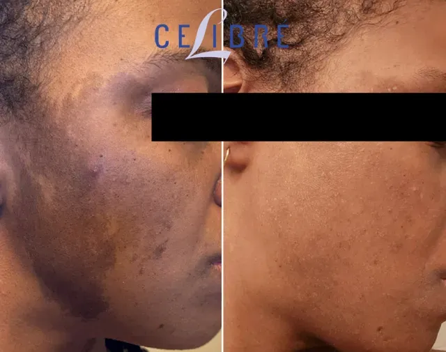 Black-skin-nevus-of-ota-laser shows significant fading and smoother, more even-toned skin.