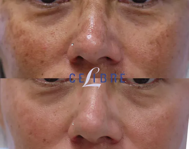 Get radiant skin with cheek-brown-spots-asian-skin-removal for a smoother, even-toned complexion