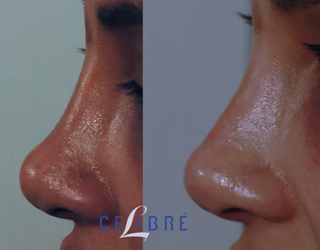 Enhance your features with ethnic-nose-filler-injections for a natural, balanced, and refined look