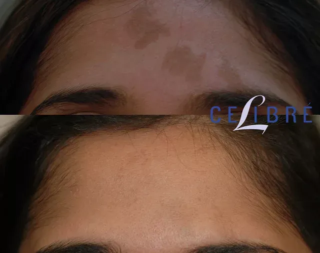 Achieve clear, smooth skin with laser-birthmark-removal-asian-skin-indian for visible before-and-after results
