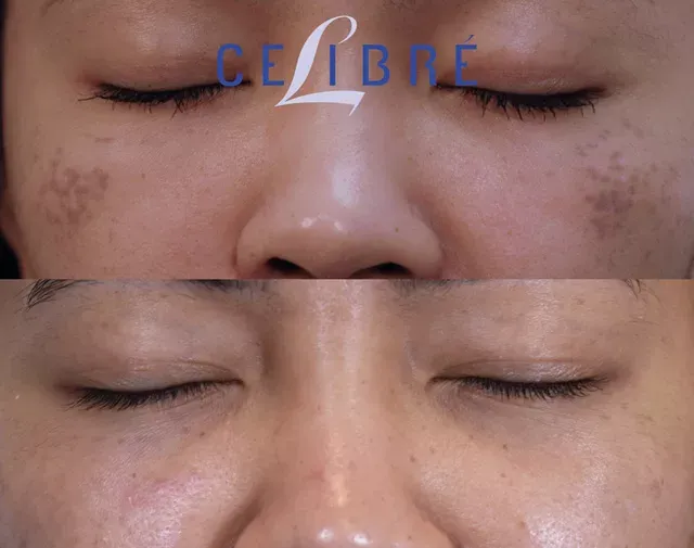 See amazing results with Vietnamese-asian-skin-laser-birthmark-removal for smoother, clearer skin