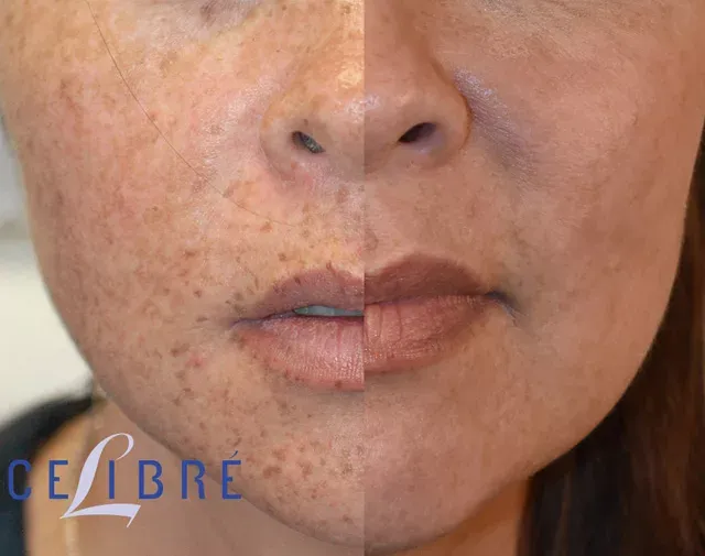 Restore clear skin with Asian-skin-freckle-removal-with-IPL-jpg for a smooth, radiant complexion