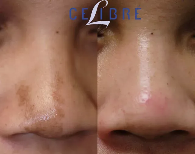 Achieve flawless results with brown-nose-birthmark-removal-asian-skin-laser for clearer, radiant skin