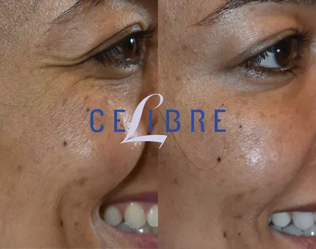 Discover top Botox-near-me services for youthful, natural results and refreshed confidence today