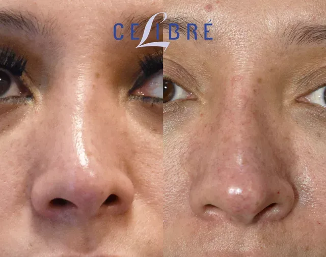 See stunning results with Juvederm-nose-shaping-before-and-after transformations