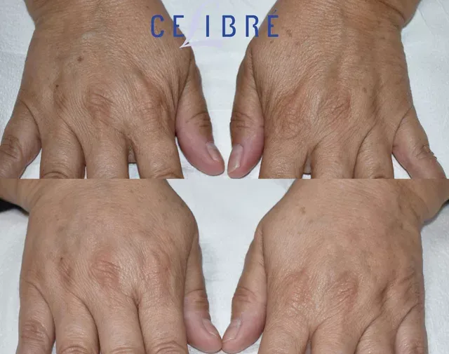 Radiesse-injections-for-hands-before-after shows fuller, smoother hands with restored youthful appearance.