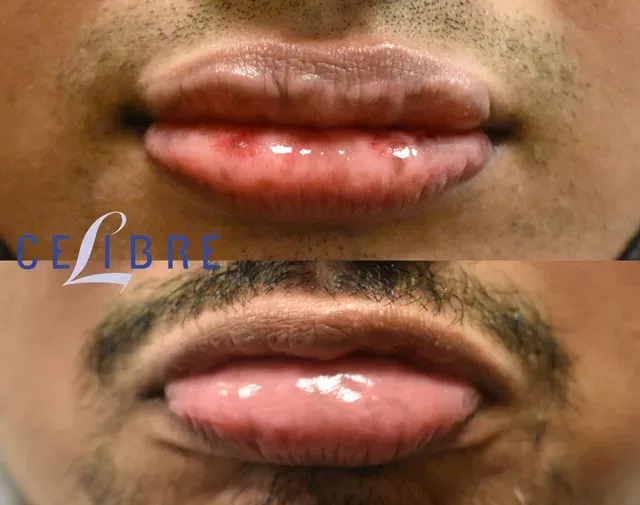 Achieve a clear, even-toned smile with lip-brown-spots-before-after-laser results