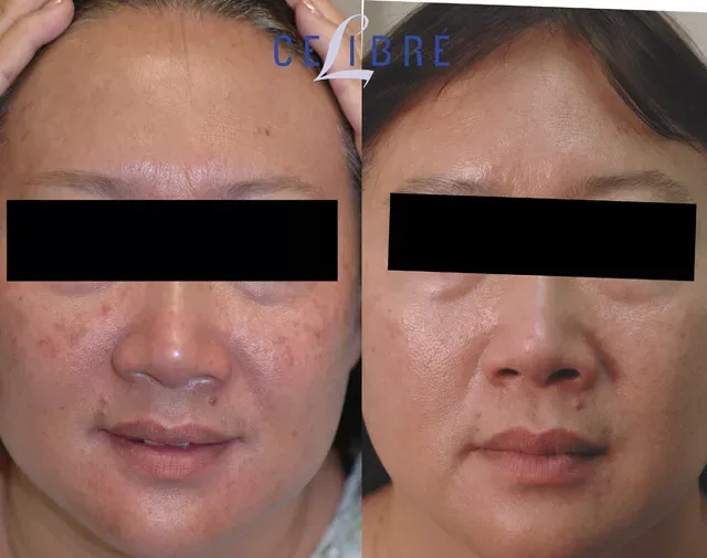 Brighten your complexion with cheek-sun-spots-removal-with-laser-asian-skin for smooth, even-toned skin