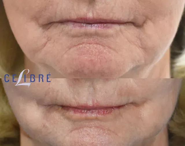 Significant improvement in puppet lines below the mouth with Radiesse, as shown in these before and after photos.