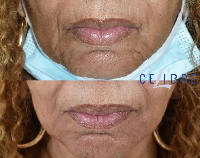 Significant improvement in folds around the mouth with Radiesse, as shown in these before and after photos.