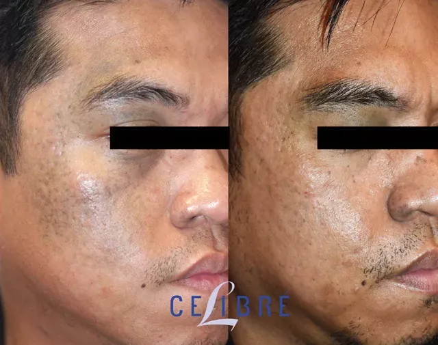 See visible results of nevus-of-ota-birthmark-removal-thai-asian-skin with advanced laser care