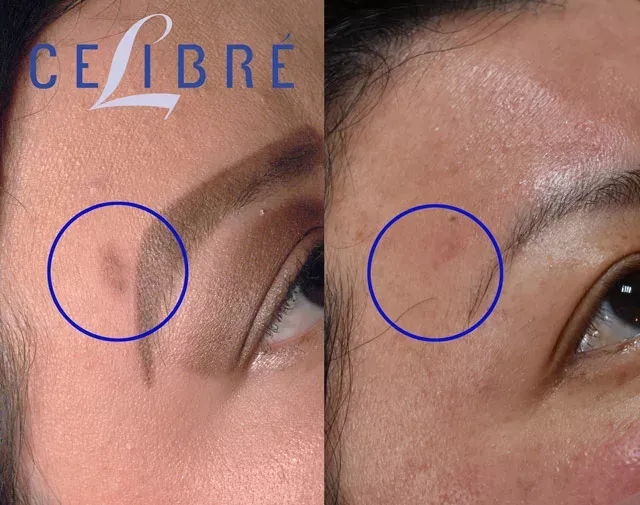 Transform your look with Mole-removal-before-after-asian-skin results for smoother, flawless beauty