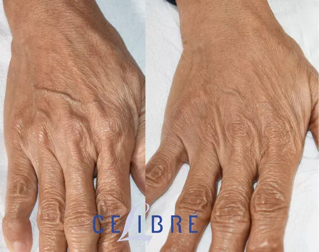 Significant improvement in hand rejuvenation with Radiesse, as shown in these before and after photos.