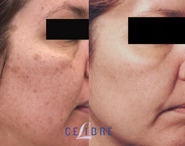 Experience IPL-age-spot-removal-laser-asian-skin for brighter, clearer, and youthful-looking complexion