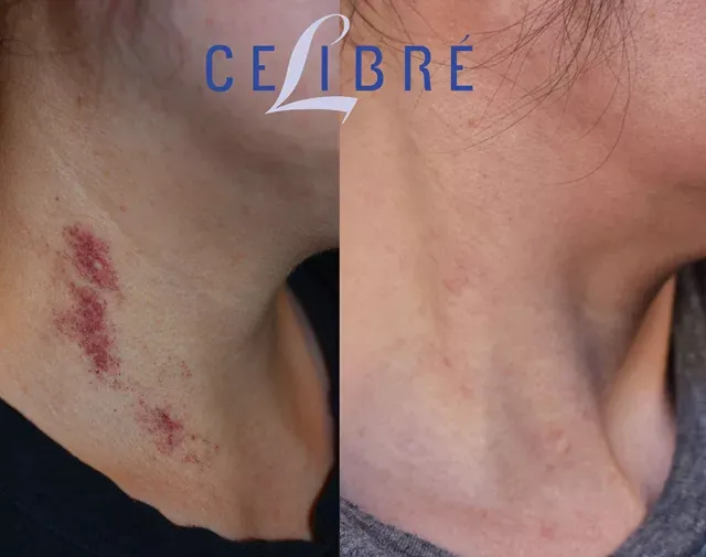 Significant improvement in Port Wine Birthmark removal with Vbeam laser, as shown in this before and after.