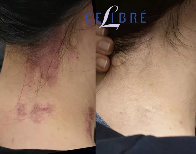 Significant improvement in red birthmark removal with Vbeam laser, as shown in this before and after comparison.