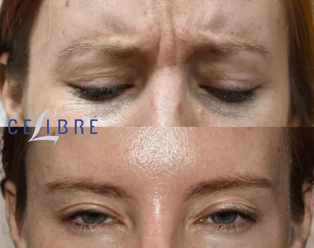 Relax-frown-lines-botox-before-after-photos – smooth, refreshed, and youthful results.