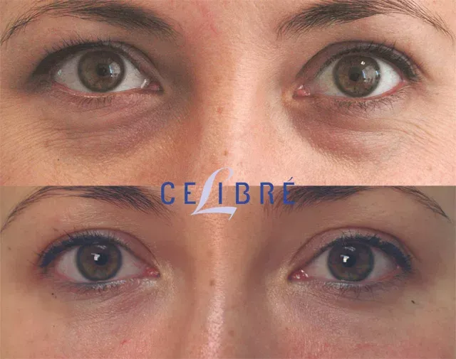 Before & After: Say Goodbye to Tired Eyes: Our advanced dark circles treatment visibly brightens and refreshes the under-eye area no more looking tired all the time!