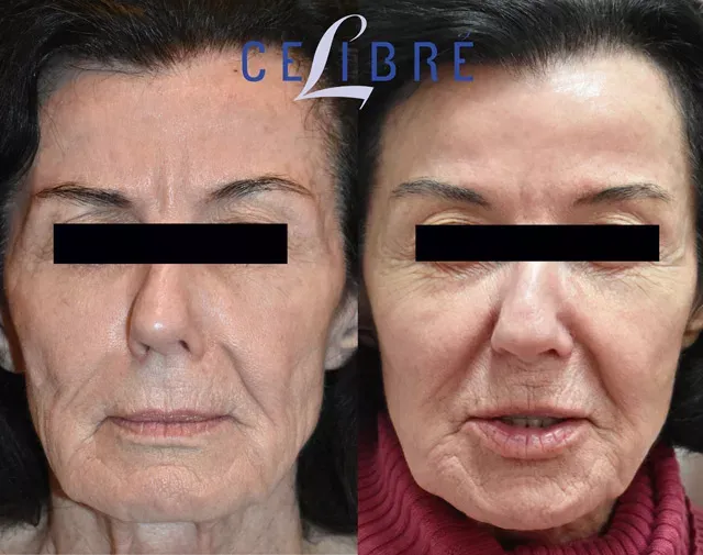 Sculptra can restore volume to the cheeks, providing a subtle lift and a more youthful look.