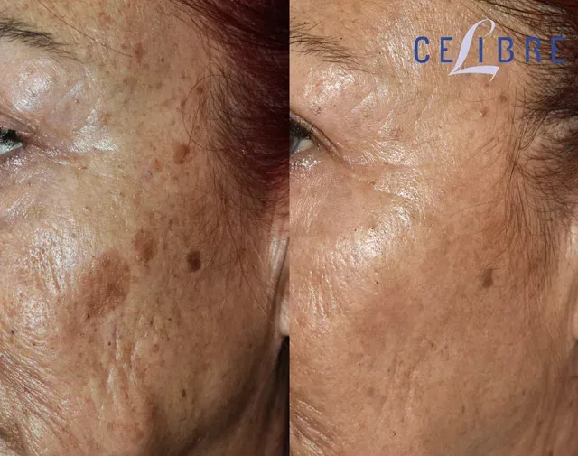 Discover safe liver-spot-removal-with-laser-asian-skin treatments for clearer, youthful-looking skin