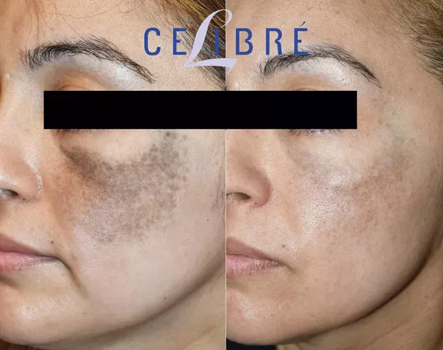 Remarkable improvement in Nevus of Ota birthmark removal with laser treatment, as shown in these before and after photos.