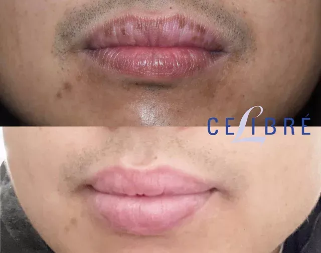 Effective solutions for brown-spots-on-the-lip-removal-Filipino-skin to restore natural beauty