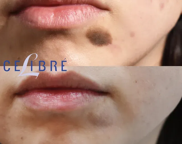 Achieve clear, smooth skin with mole-birthmark-removal-face-laser-before-after results
