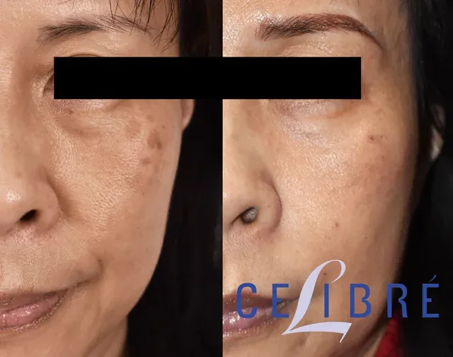 Asian skin transformation with brown spot removal lasers