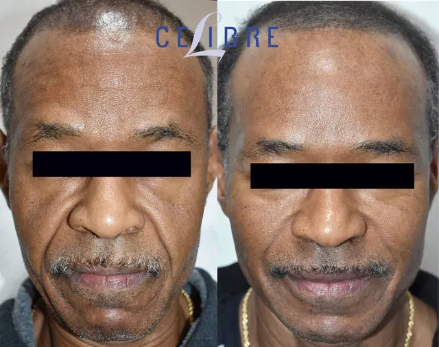 Witness the incredible before-and-after of Sculptra for men, restoring a more youthful and defined appearance.