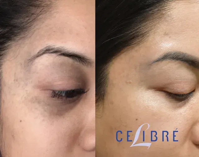 Significant improvement in Nevus of Ota birthmark removal with Picosure laser, as seen in this comparison.