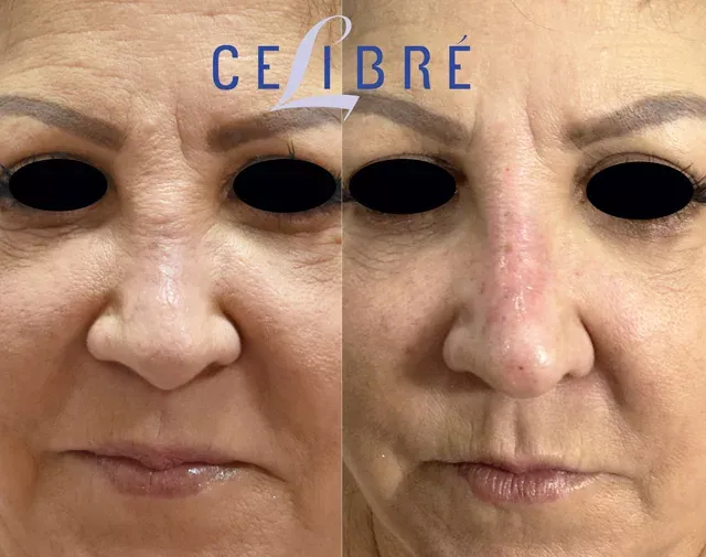 Transform your profile with Restylane-for-non-surgical-nose-job-pictures results