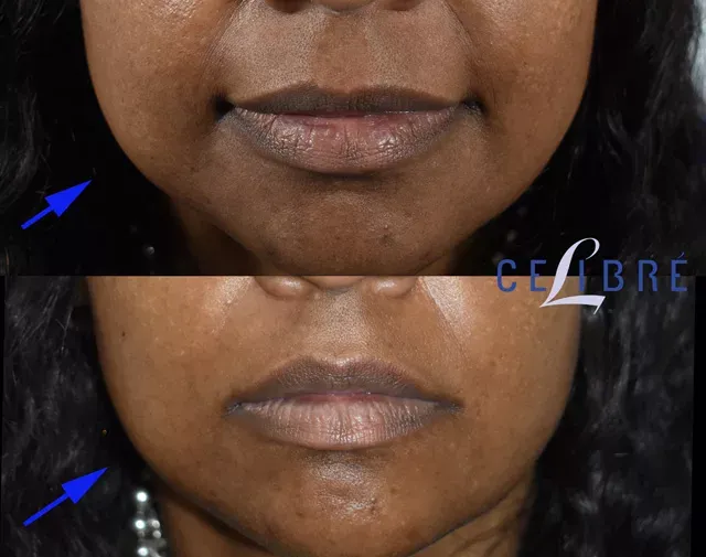 Enhance facial contours with jaw-shaping-with-botox-before-after results