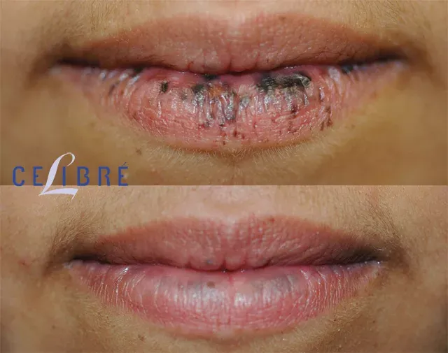 See smoother, spotless lips with laser-for-lip-spots-before-after results