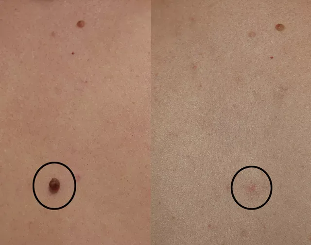 Mole-removal-before-and-after shows clear, smooth skin with effective and precise removal results.