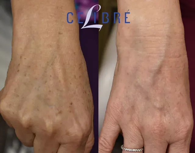 Remove-liver-spots-on-hands-with-laser-before-after shows clearer, younger-looking hands with noticeable spot reduction.