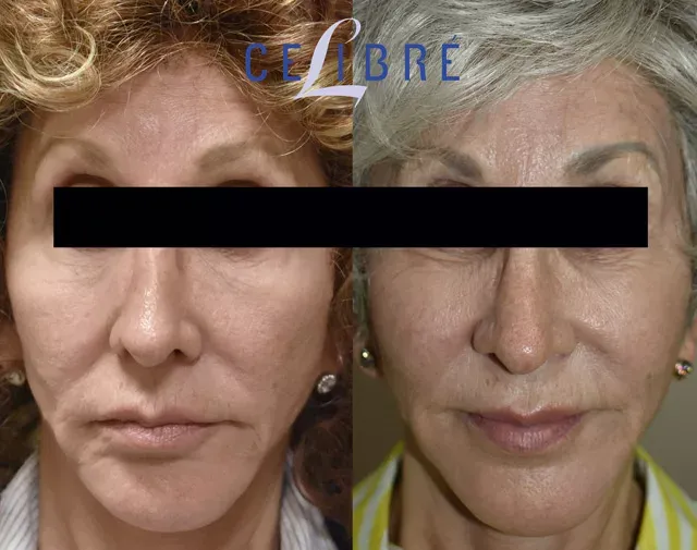 Sculptra is an effective treatment for cheeks, restoring volume and providing a more youthful, contoured appearance.