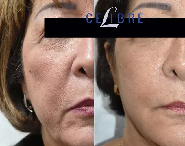 Sculptra liquid facelift provides a more youthful and defined appearance, restoring lost volume and smoothing fine lines.
